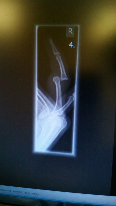 Woche der Verletzungen beim FSV Schleiz!